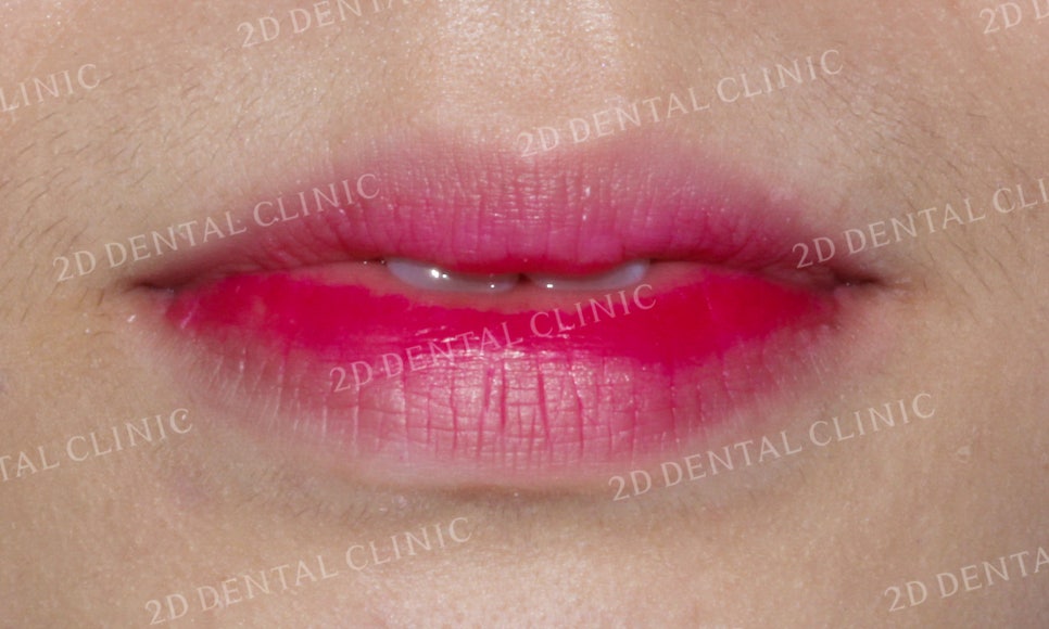 [앞니교정] 부정교합 교정, 앞니교정으로 부정교합 교정하는 방법! by. 투디치과(2D치과) 관련 이미지 7