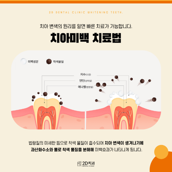 치아착색음식 때문? 양치해도 치아가 누런 이유 관련 이미지 5