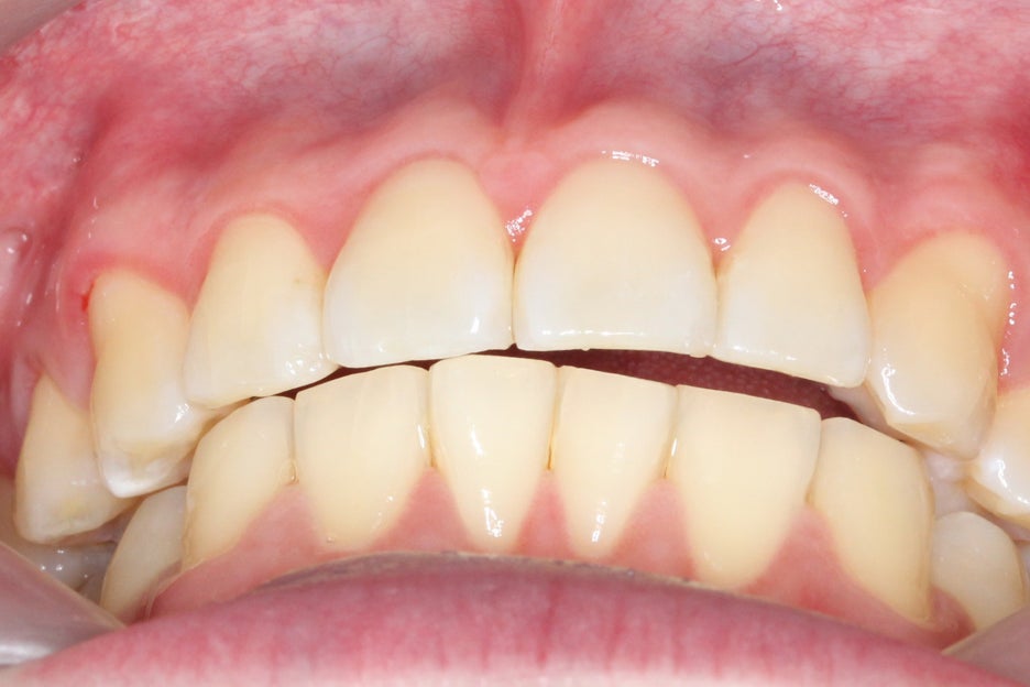 논현동치과 윗니부분교정 후기 관련 이미지 8