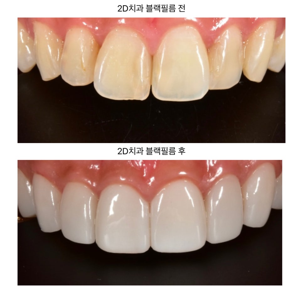 연예인 라미네이트 치아삭제없는 무삭제라미네이트 블랙필름 관련 이미지 9