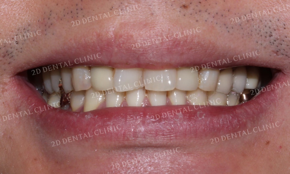 [2D교정] 나비치아교정을 2D교정 장치로 빠르게 완성하기! by.2D치과(투디치과) 관련 이미지 3