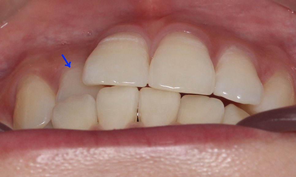 신논현치과 자가결찰브라켓 장점 관련 이미지 3