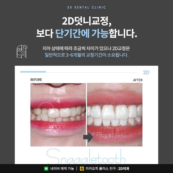 덧니가 두드러져 스트레스일 땐? 2D부분교정 관련 이미지 6