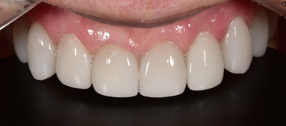 앞니깨짐 (앞니파절) 치료방법 세 가지 - 레진, 라미네이트, 크라운 관련 이미지 8