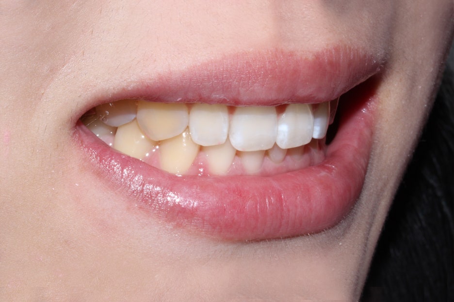 벌어진앞니 치간이개 공간 삭제하기! 관련 이미지 7