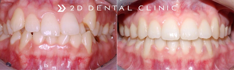 [2D치과]치아총생(Crowding)이란? 관련 이미지 1