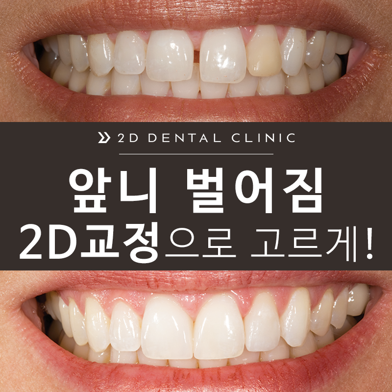 벌어진 앞니, 투디(2D)교정으로 치열을 고르게! 관련 이미지 1
