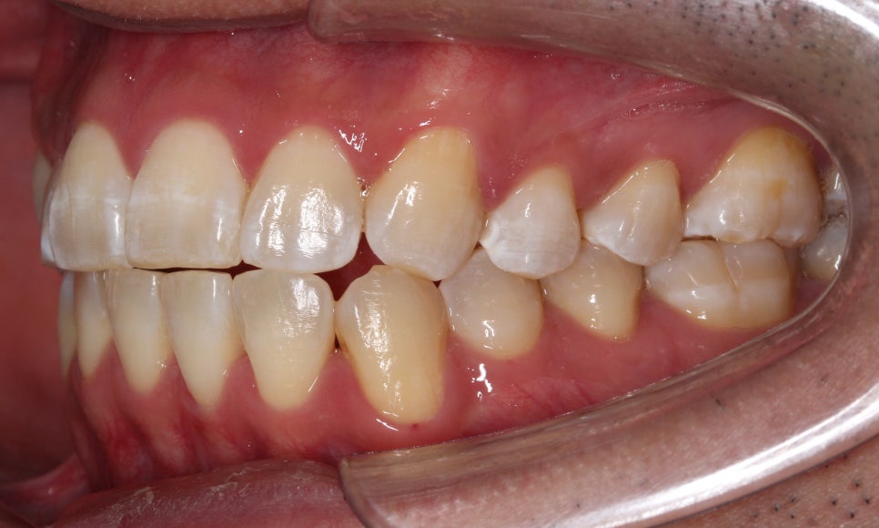 앞니 덧니 고민, 부분 설측 교정으로 해결한 사례 관련 이미지 12