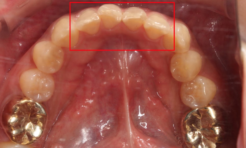 토끼앞니교정, PFM크라운 재보철을 동시에 치료하는 방법? 관련 이미지 7