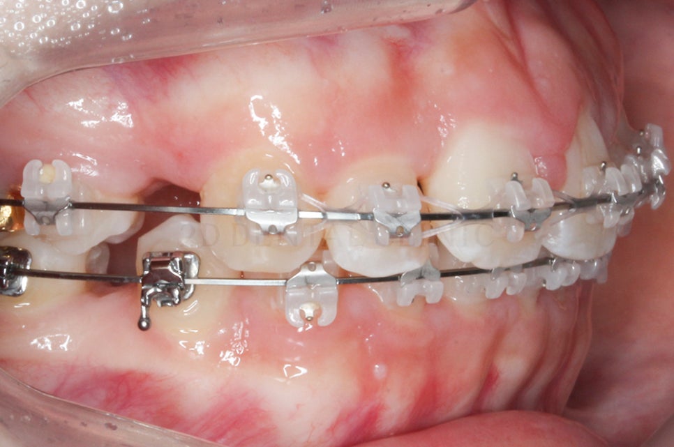 [돌출입 무턱] 안모교정 진행중! by.투디치과(투디치과)전체교정 관련 이미지 6