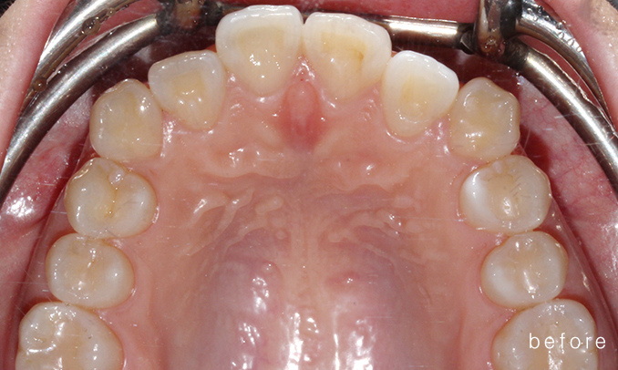 우디의 교정 일기ㅣ부정 교합 치아교정 후기 관련 이미지 8