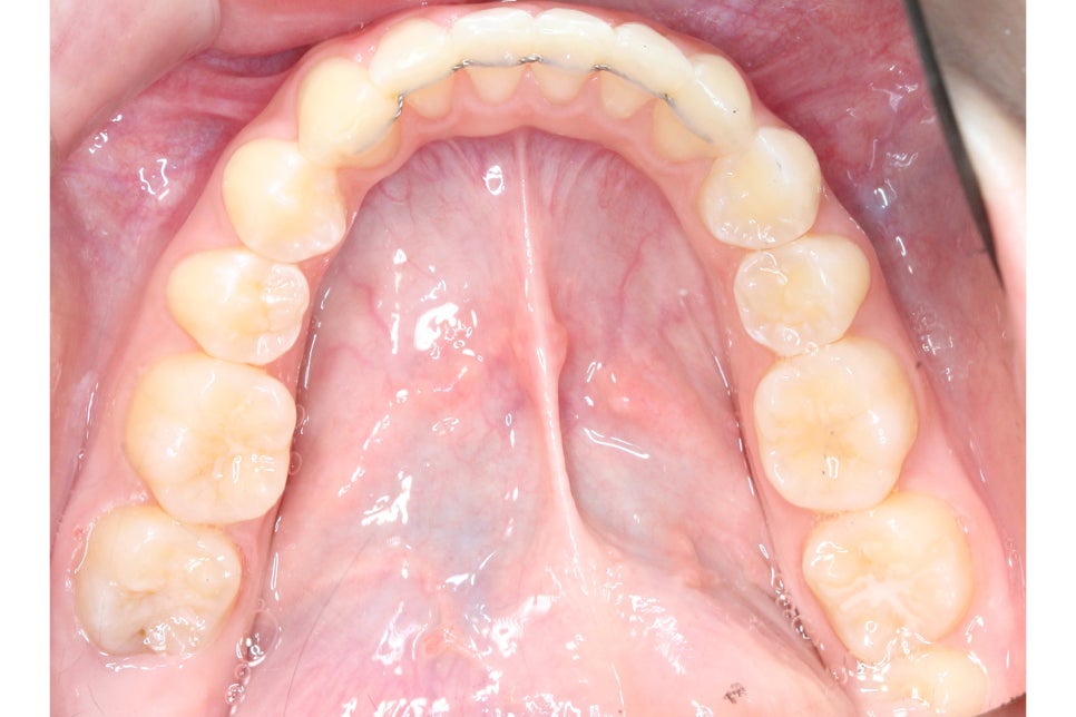 투디치과 송곳니덧니 치료 후기 관련 이미지 14