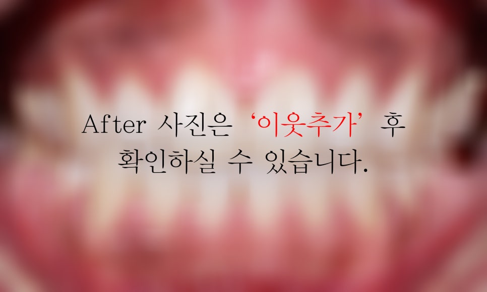 아랫니 부분교정 2D교정(설측교정)으로 가능할까? 관련 이미지 6