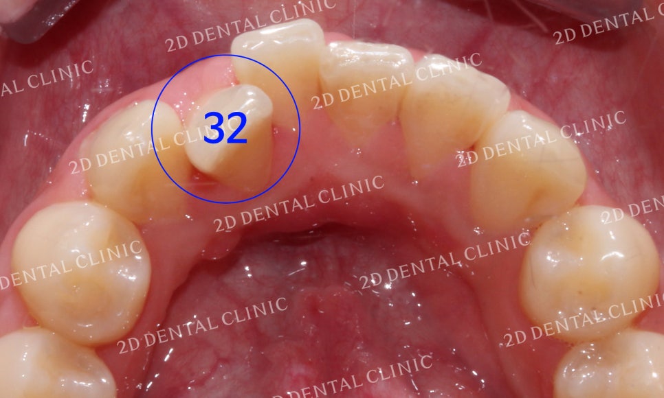 [투디교정] 덧니치아교정, 부분교정으로 쉽고 빠르게! by.투디치과(2D치과) 관련 이미지 6