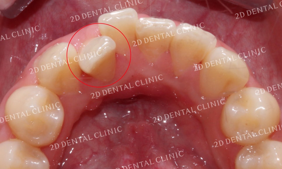 [투디교정] 덧니치아교정, 부분교정으로 쉽고 빠르게! by.투디치과(2D치과) 관련 이미지 15