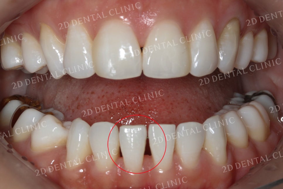 치아틈새를 완벽하게 메꾸자! 블랙트라이앵글 쎄라필름으로 완전 삭제! by.투디치과(2D치과) 관련 이미지 7