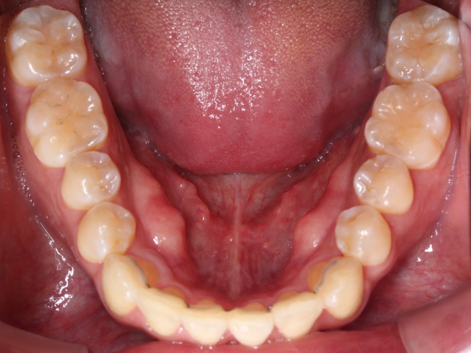 앞니 덧니 고민, 부분 설측 교정으로 해결한 사례 관련 이미지 17
