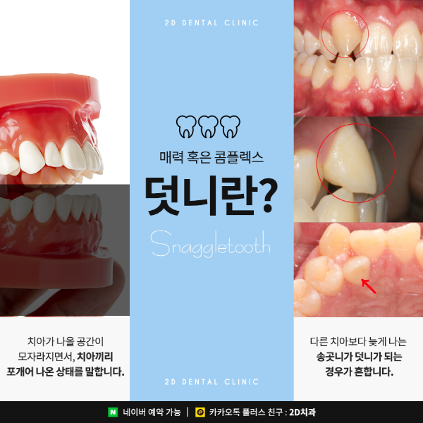 덧니가 두드러져 스트레스일 땐? 2D부분교정 관련 이미지 2