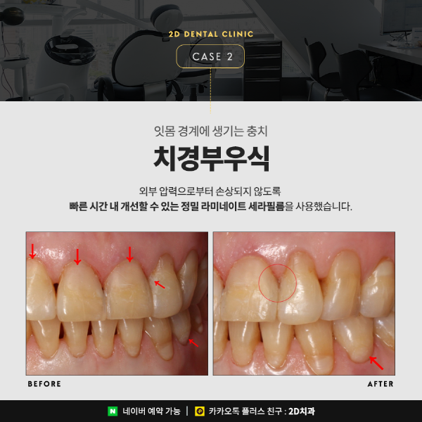 앞니깨짐, 치아변색 앞니고민 해결사! <세라필름 &middot; 블랙필름> 관련 이미지 5
