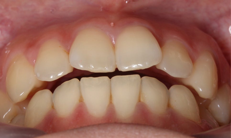 나비앞니 세라믹교정 case 관련 이미지 2