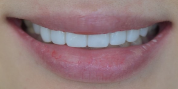 무삭제라미네이트잘하는곳 치아성형 2D치과 블랙필름 관련 이미지 2