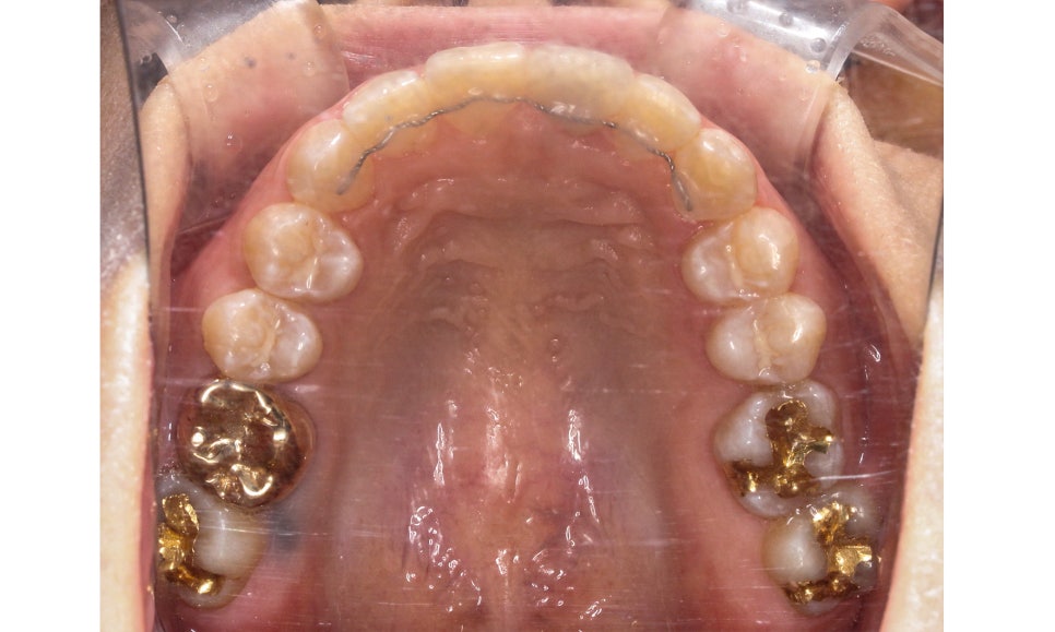양악교정 송곳니교정 중심으로 관련 이미지 14