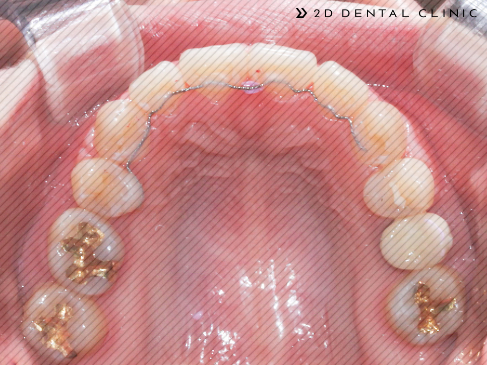 발치교정 돌출입 케이스, 교정전문 2D치과 관련 이미지 10