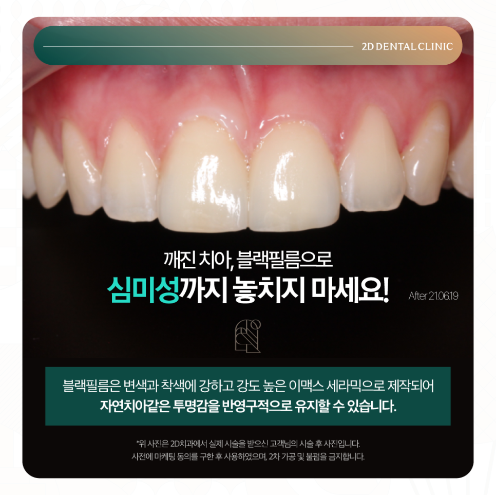 무삭제라미네이트비용 치아깨짐 파절된 앞니 보완하고 싶다면 관련 이미지 6