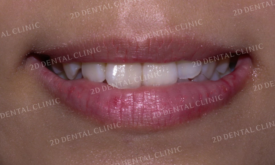 토끼앞니, 튀어나온 앞니 부분교정 후기! by.투디치과(2D치과) 관련 이미지 8