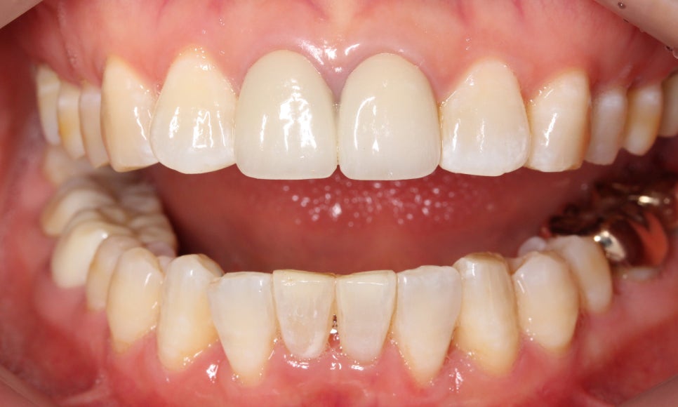 2D교정으로 아랫니 부분교정 빠르게 완성하기! 관련 이미지 7