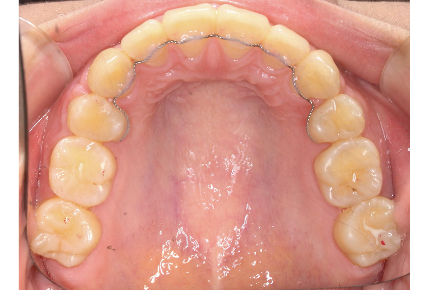 입돌출 데이몬교정 Case1 관련 이미지 14