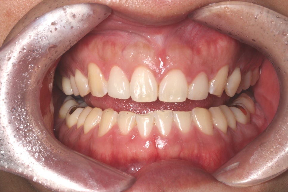 평생 소장! 앞니보철은 자연스러운 2D치과(투디치과) BLINX(블링스)로! 관련 이미지 8