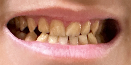 무삭제 라미네이트 개인의 치아디자인에 맞춘 단 하나밖에 없는 치아디자인 블랙필름 관련 이미지 2