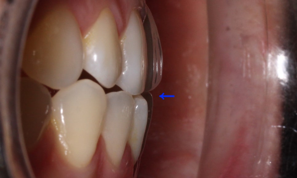 절단교합 클리피씨 교정 방법 관련 이미지 3