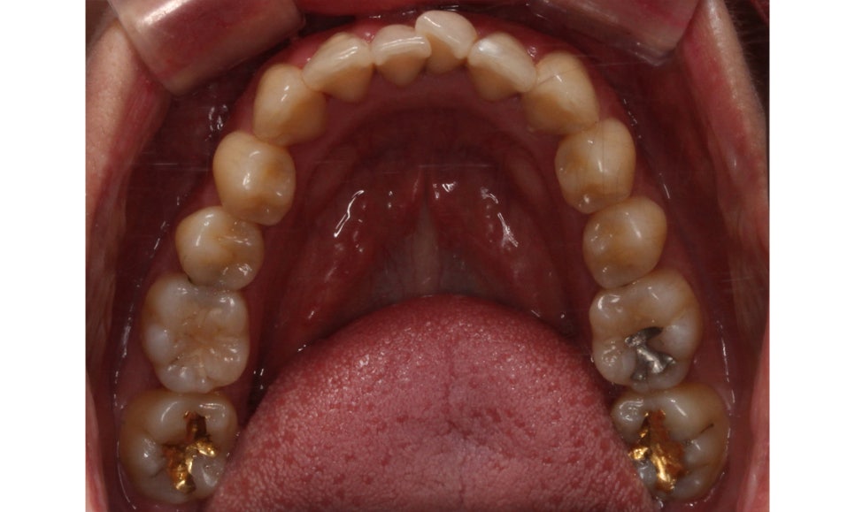 입툭튀 교정 신논현역치과 전체교정으로 관련 이미지 7