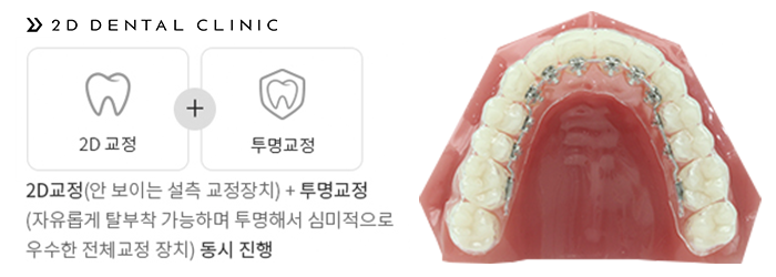 2D Plus+(플러스) 교정, 심한 케이스도 티 나지 않게! 관련 이미지 3