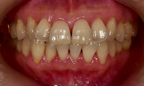 무삭제 라미네이트 교정 고민중이라면? 관련 이미지 6