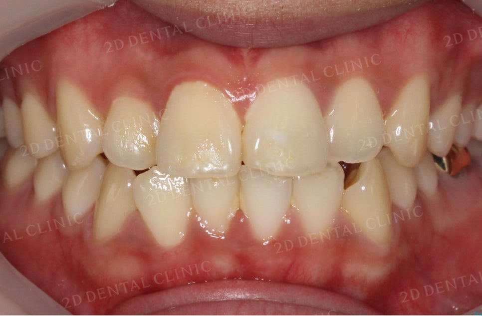 [앞니교정] 토끼앞니교정, 클리피씨 교정으로 완벽하게! by.투디치과(2D치과) 관련 이미지 2