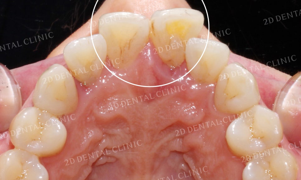 [앞니교정] 돌출앞니교정, 토끼앞니를 클리피씨교정으로 완성하기! by. 투디치과(2D치과) 관련 이미지 6