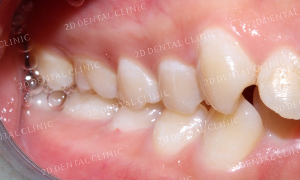 돌출앞니 교정, 튀어나온 입을 넣어보자! by.투디치과(2D치과) 관련 이미지 8
