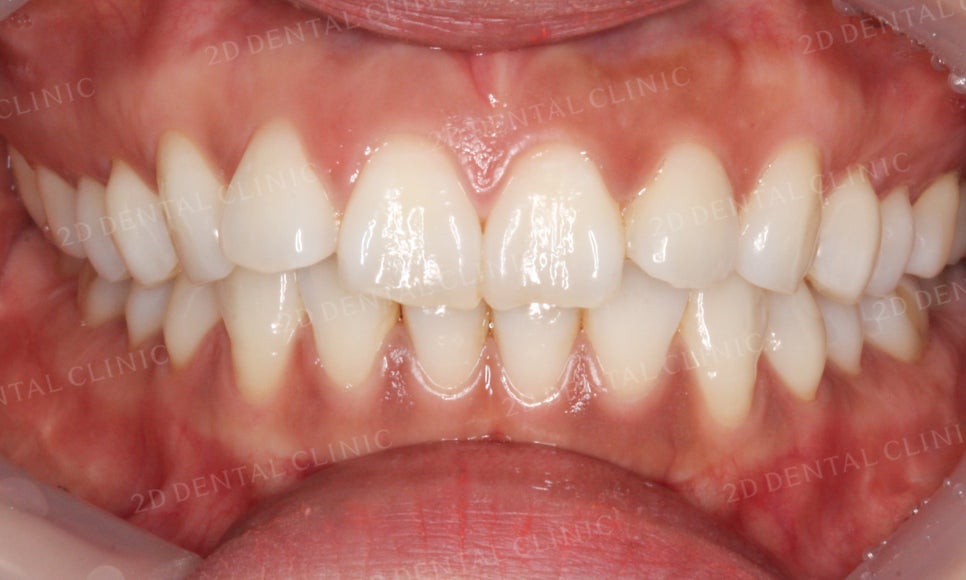 [부분교정] 틀어진 앞니, 부분교정으로 앞니교정하기! by.투디치과(2D치과) 관련 이미지 16