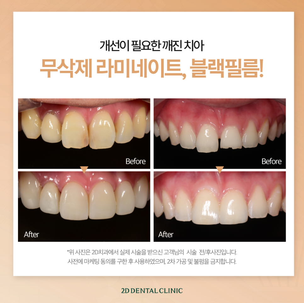 대구무삭제라미네이트 앞니깨짐비용보다 이것에 집중해 주세요! 관련 이미지 7