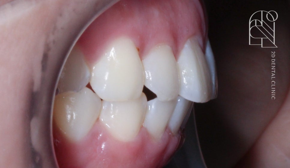 부정교합 치아교정, 전체교정으로 완성하기! by. 투디치과(2D치과) 관련 이미지 11