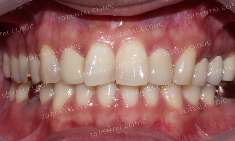 [2D교정] 나비치아교정을 2D교정 장치로 빠르게 완성하기! by.2D치과(투디치과) 관련 이미지 13