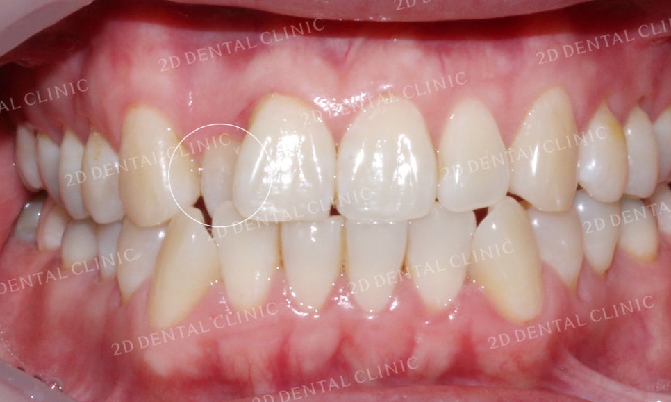[앞니교정]부정교합교정, 부분교정으로 완성하기! by.투디치과(2D치과) 관련 이미지 13