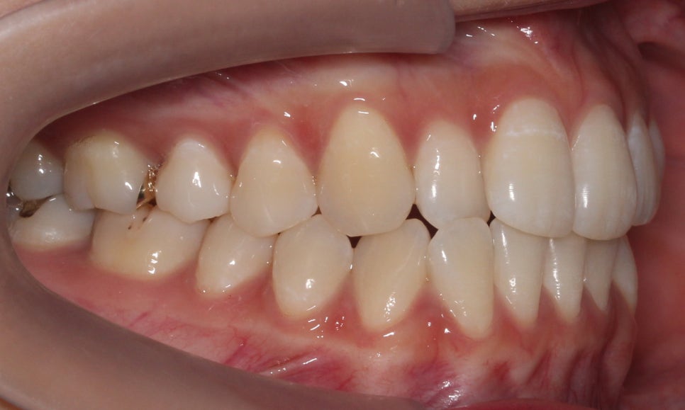 신논현치과 자가결찰브라켓 장점 관련 이미지 5