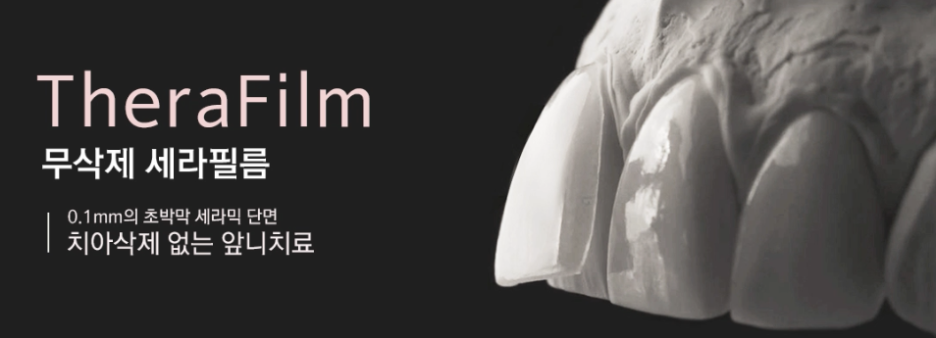 라미네이트 치료 전 체크해야할 부분은? 관련 이미지 2