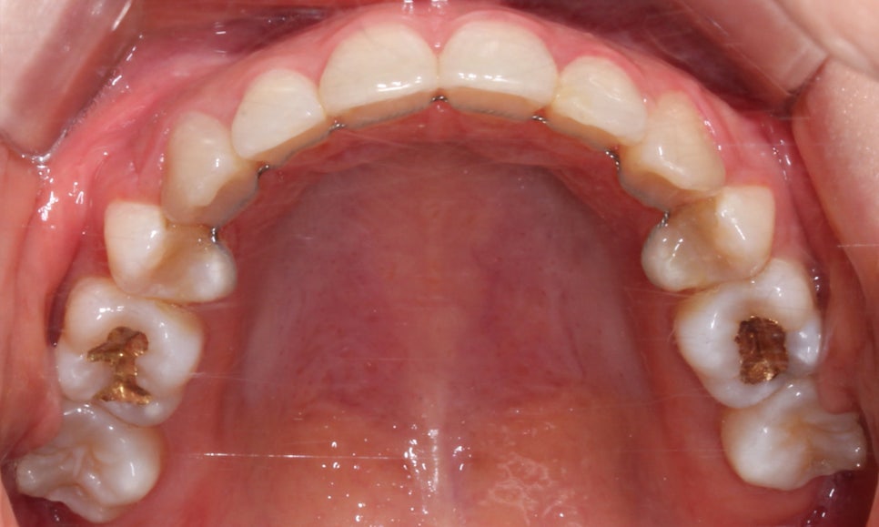 역삼역치과 송곳니덧니 crowding Case 관련 이미지 13