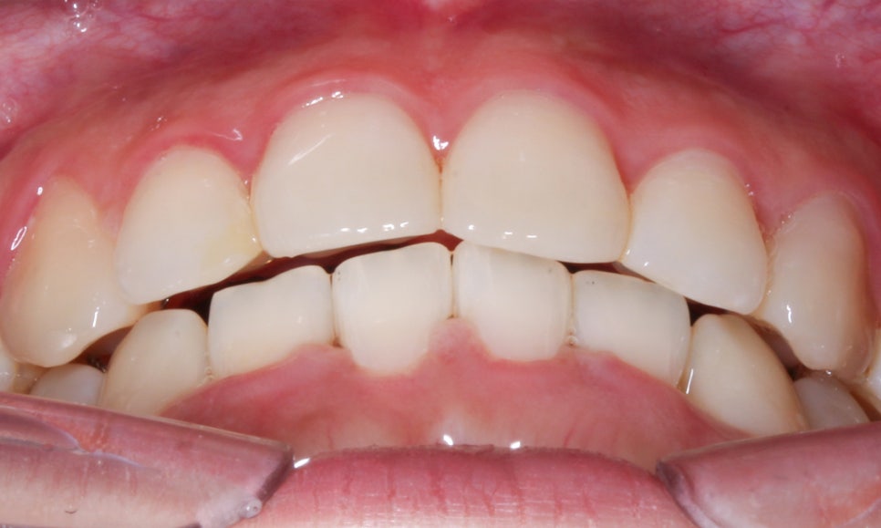 역삼역치과 송곳니덧니 crowding Case 관련 이미지 9