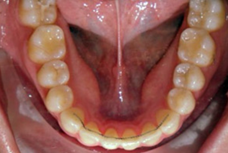교정끝나고 꼭 안쪽에 유지장치를 붙여야하나요 : 신논현역 투디치과 관련 이미지 2